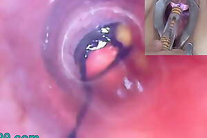 Mature Woman Peehole Endoscope Camera in Bladder with Balls